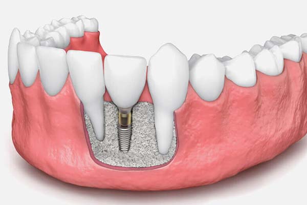 Bone grafting