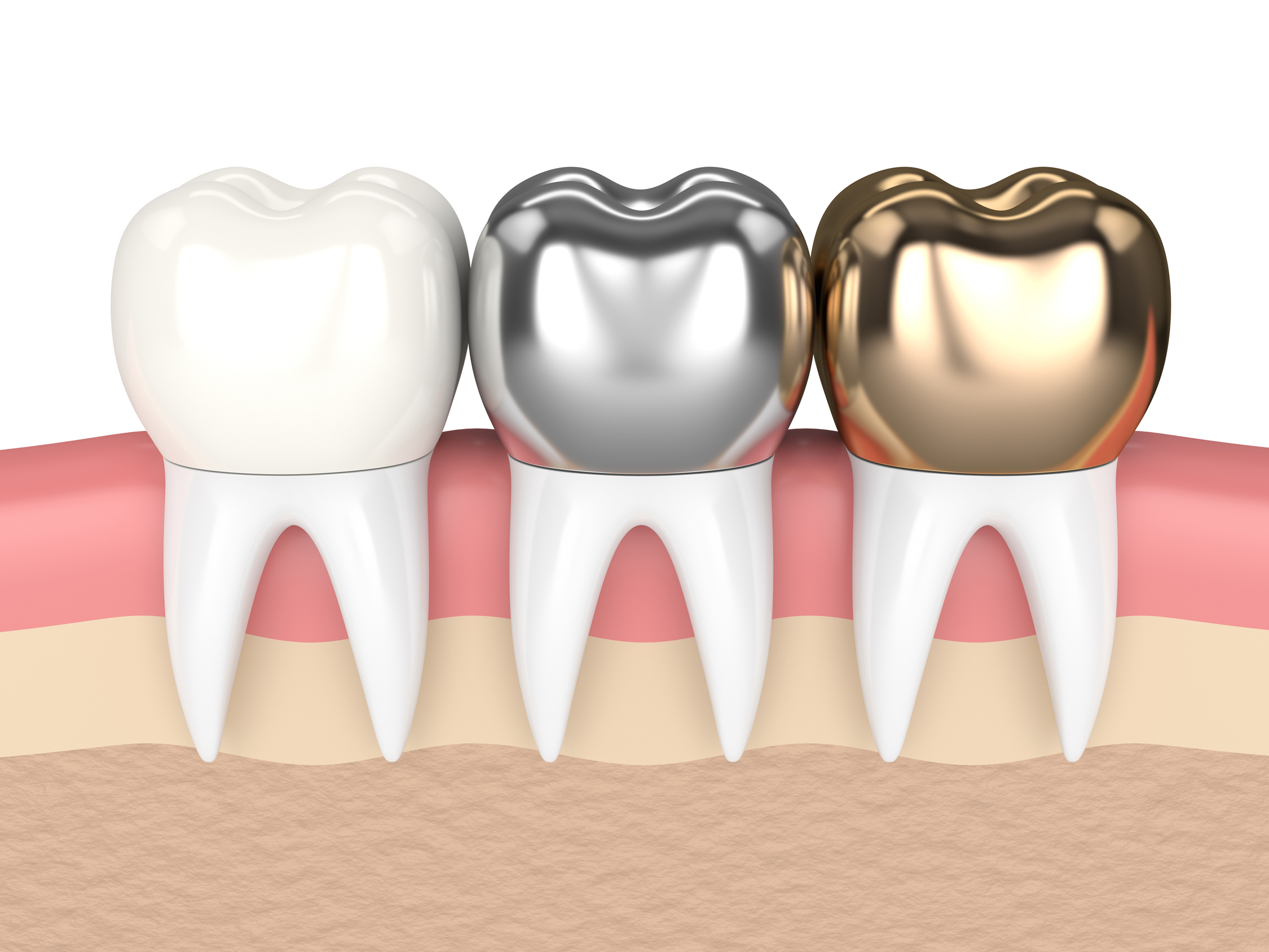 Crown placement